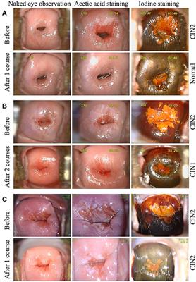 Case Report: Noninvasive Clinical Intervention of REBACIN® on Histologic Regression of High Grade Cervical Intraepithelial Neoplasia